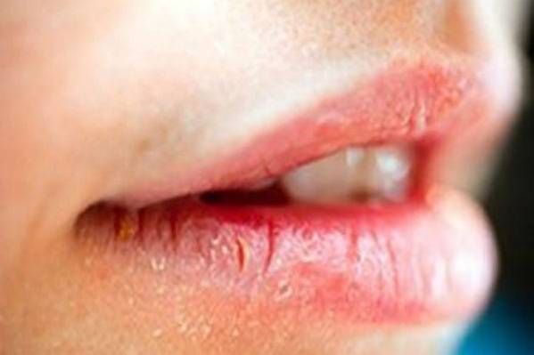 Da li su vam usta stalno suha? To može biti signal ove OZBILJNE bolesti!
