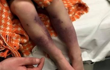 4-godišnjakinja zamalo izgubila obje noge – zbog vodenih kozica
