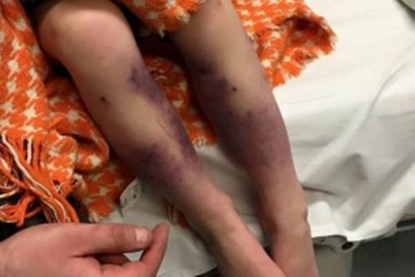 4-godišnjakinja zamalo izgubila obje noge – zbog vodenih kozica