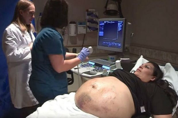 Trudnički stomak ove žene je bio prekriven modricama, ultrazvuk je otkrio zapanjujuću istinu…