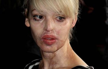 Prije devet godina dečko joj je KISELINOM unakazio lice, evo kako izgleda nakon 100 OPERACIJA! (UZNEMIRUJUĆI SADRŽAJ)