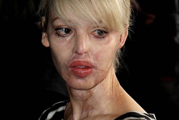 Prije devet godina dečko joj je KISELINOM unakazio lice, evo kako izgleda nakon 100 OPERACIJA! (UZNEMIRUJUĆI SADRŽAJ)