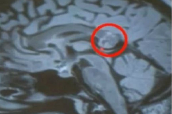 UŽAS U GLAVI: Mislila je da ima TUMOR na mozgu, ali doktori su otkrili nešto još više ZASTRAŠUJUĆE!(VIDEO)