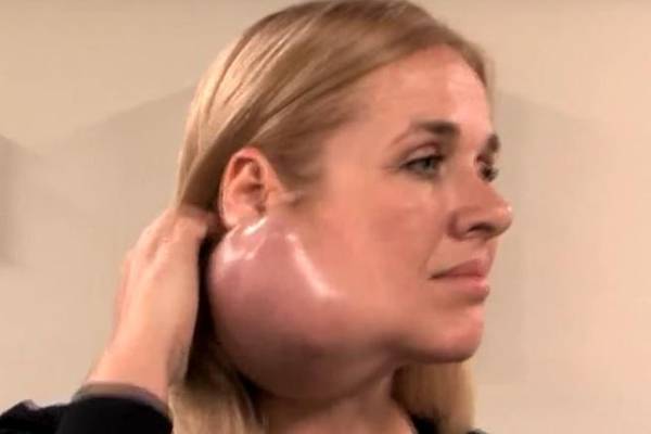 STRAŠNO:Na obrazu joj rastao TUMOR, ali ga je kosom vješto prekrivala (VIDEO)