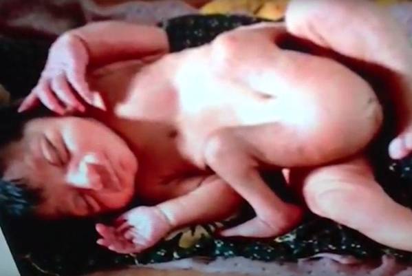 Ovo (ne) želite da vidite! Rođena beba s 4 noge i 2 p*nisa! (VIDEO)