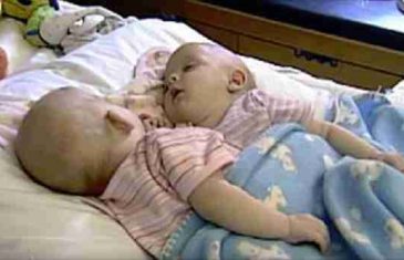 Majka je rodila spojene blizankinje. 10 godina kasnije, one izgledaju totalno drugačije!