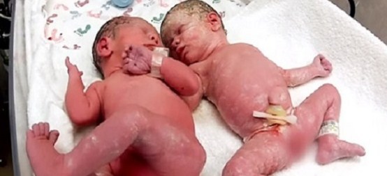 Pogledajte ovaj DIVAN prizor! Šta su uradili BLIZANCI par minuta nakon rođenja! (VIDEO)